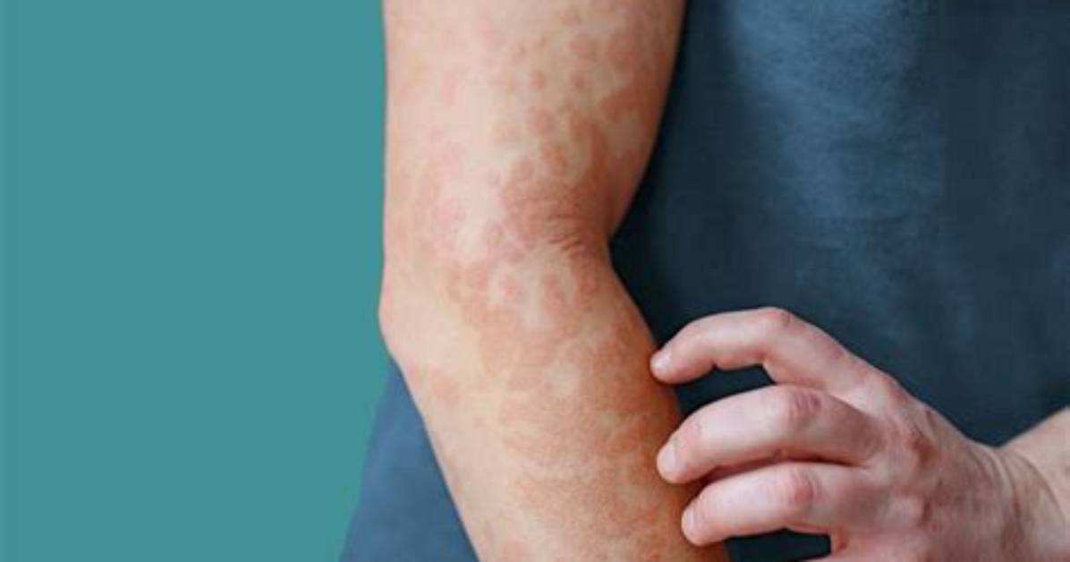 When Does Cholinergic Urticaria Go Away?