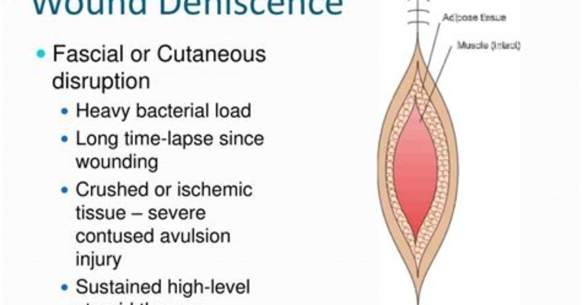 When Does Dehiscence Occur?