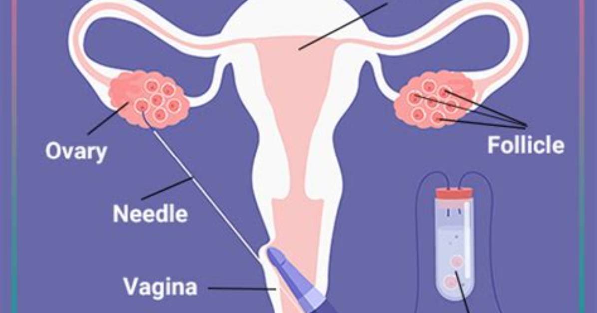 When Does Egg Retrieval Happen in Ivf?