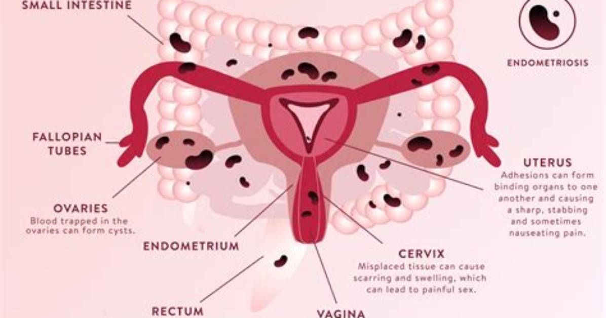 When Does Endometritis Occur?