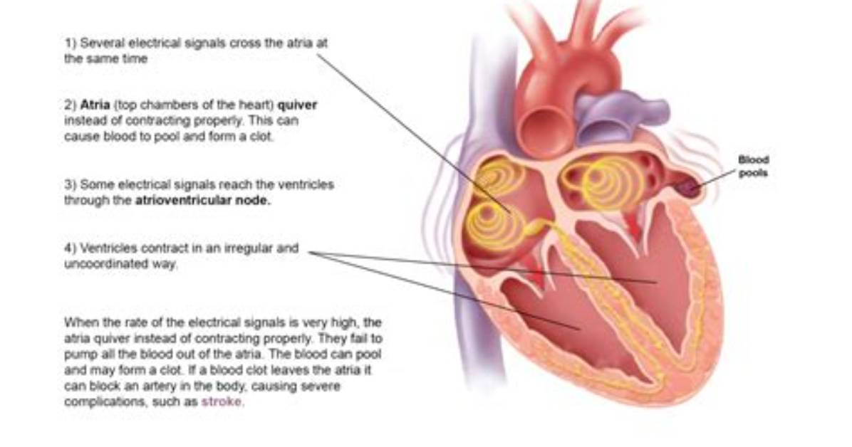 When Does Fibrillation Occur?