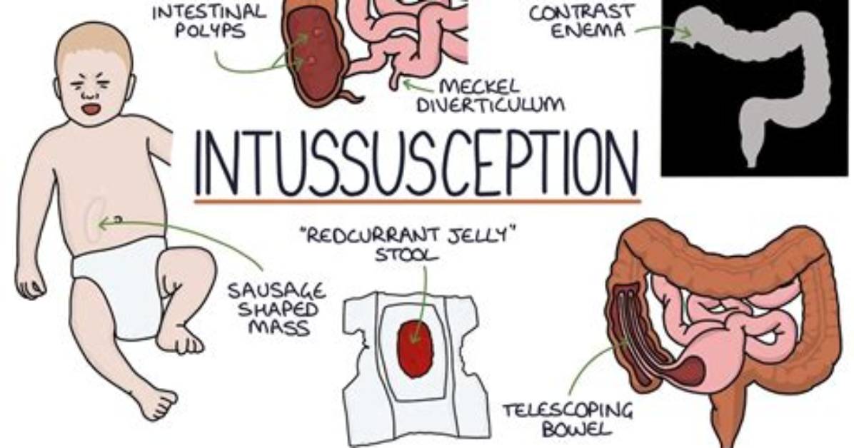 When Does Intussusception Go Away?