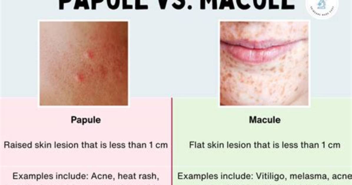 When Does Macules Occur?