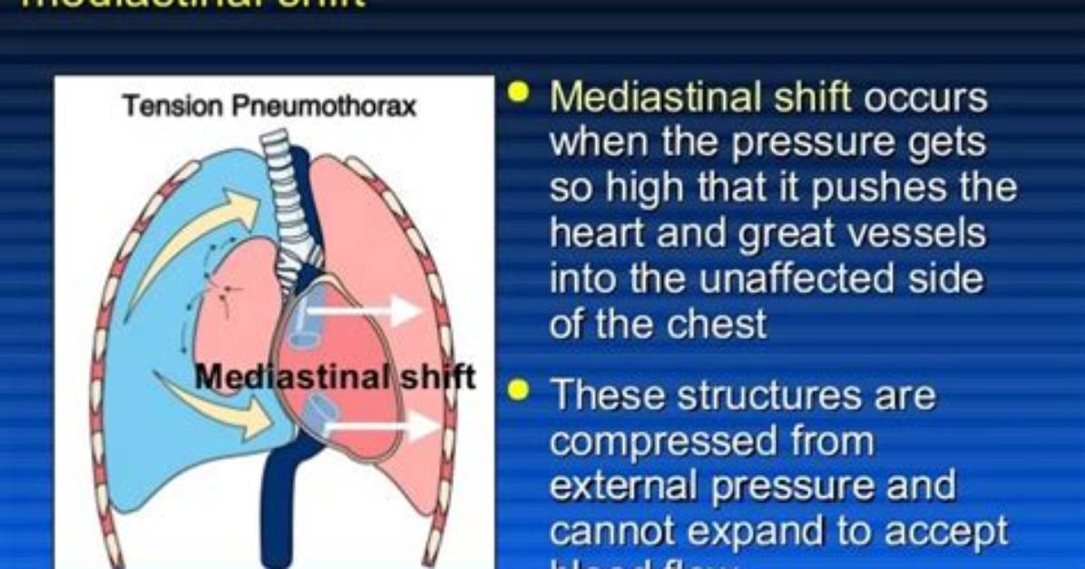 When Does Mediastinal Shift?