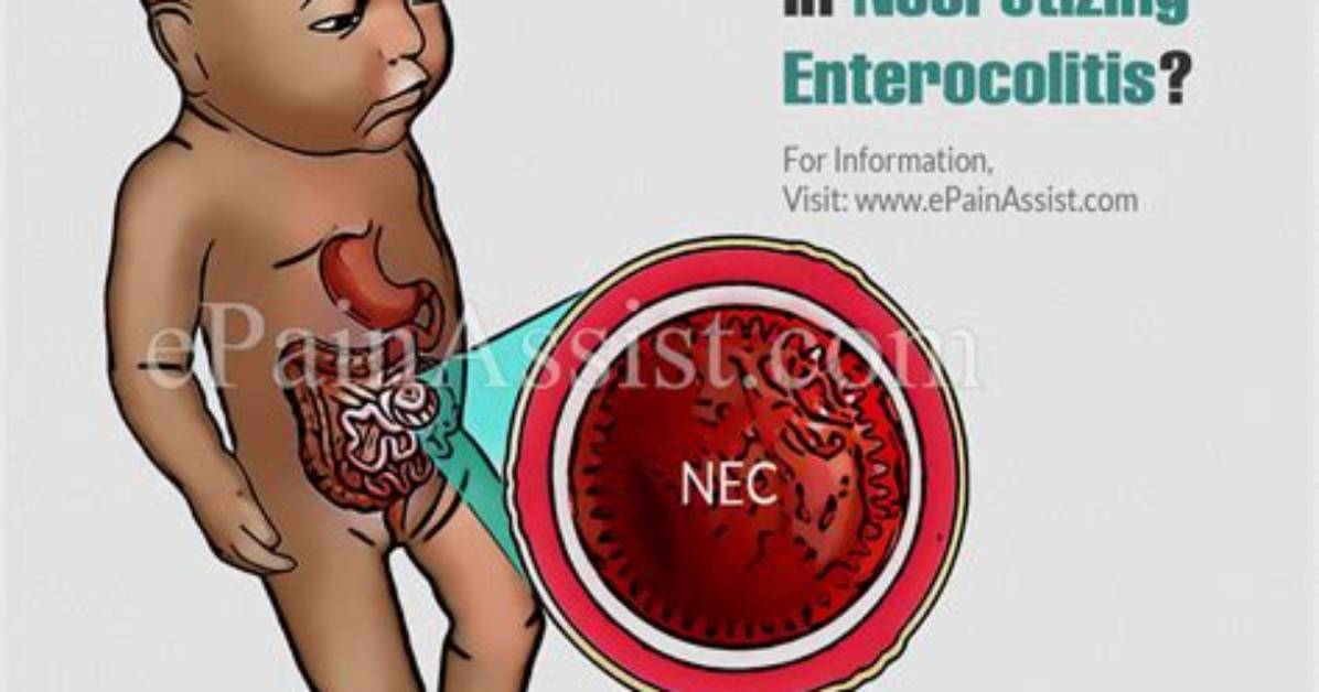 When Does Necrotizing Enterocolitis Show up?