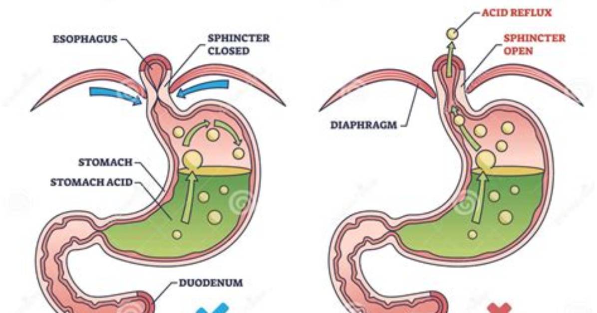 When Does Physiologic Reflux Occur?