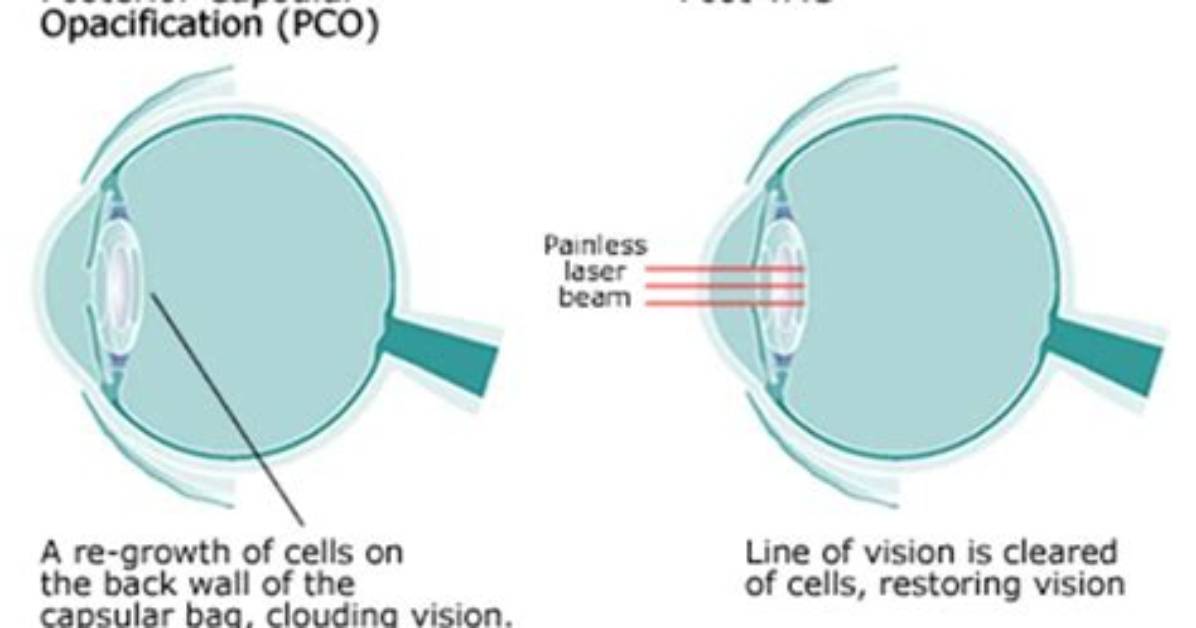 When Does Posterior Capsule Opacification Occur?