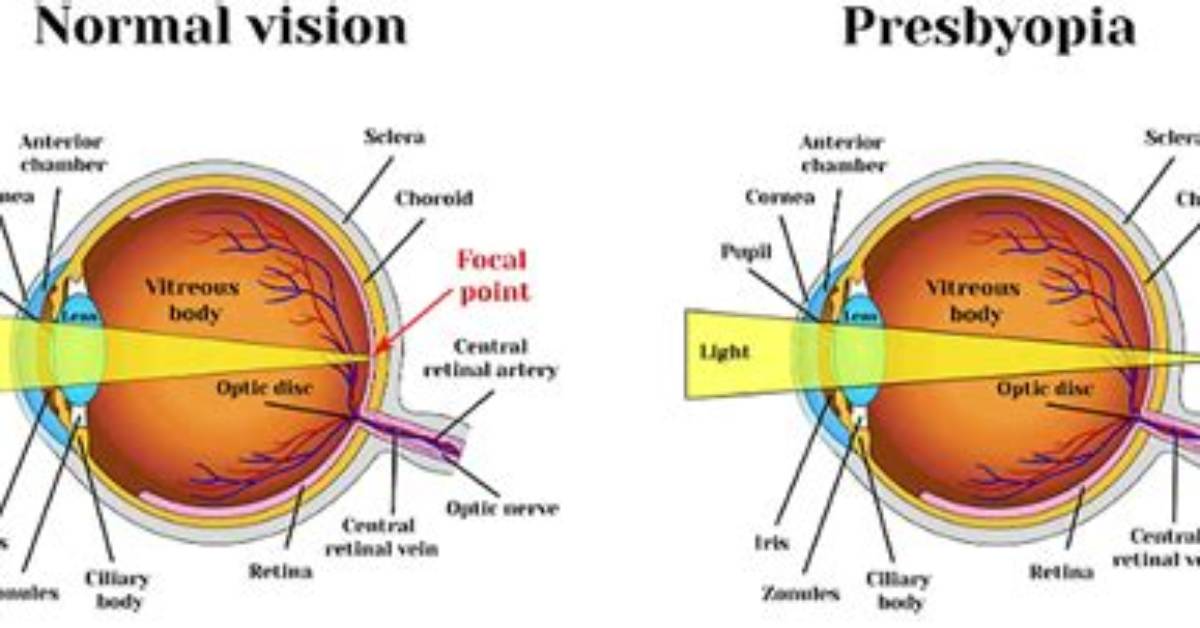 When Does Presbyopia Occur?