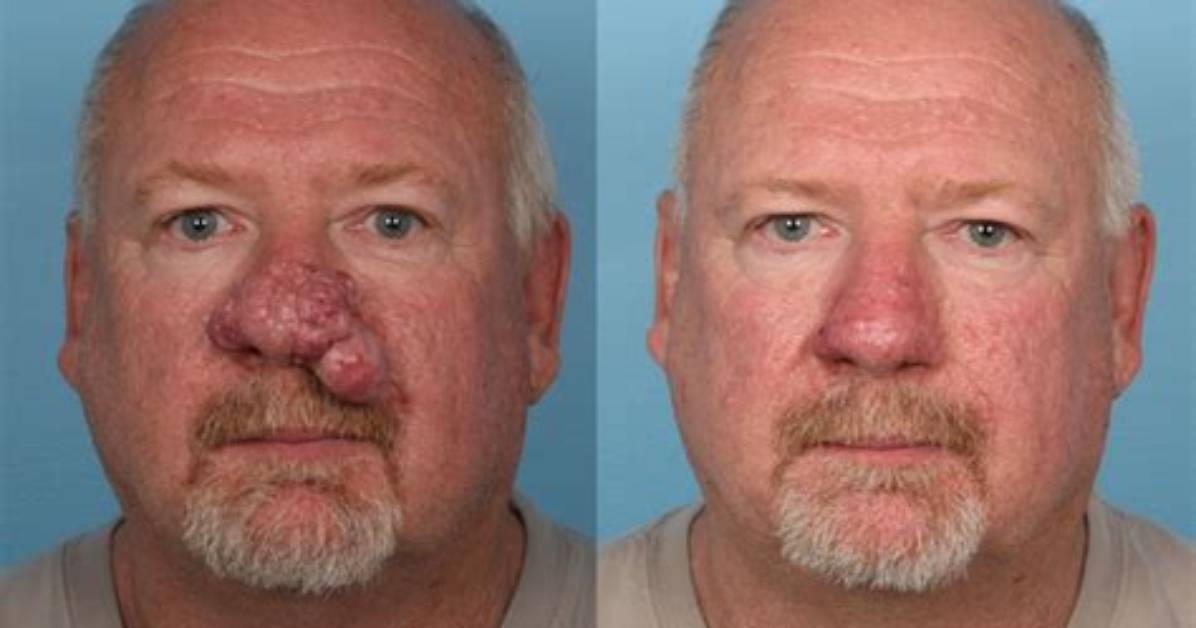 When Does Rhinophyma Start?