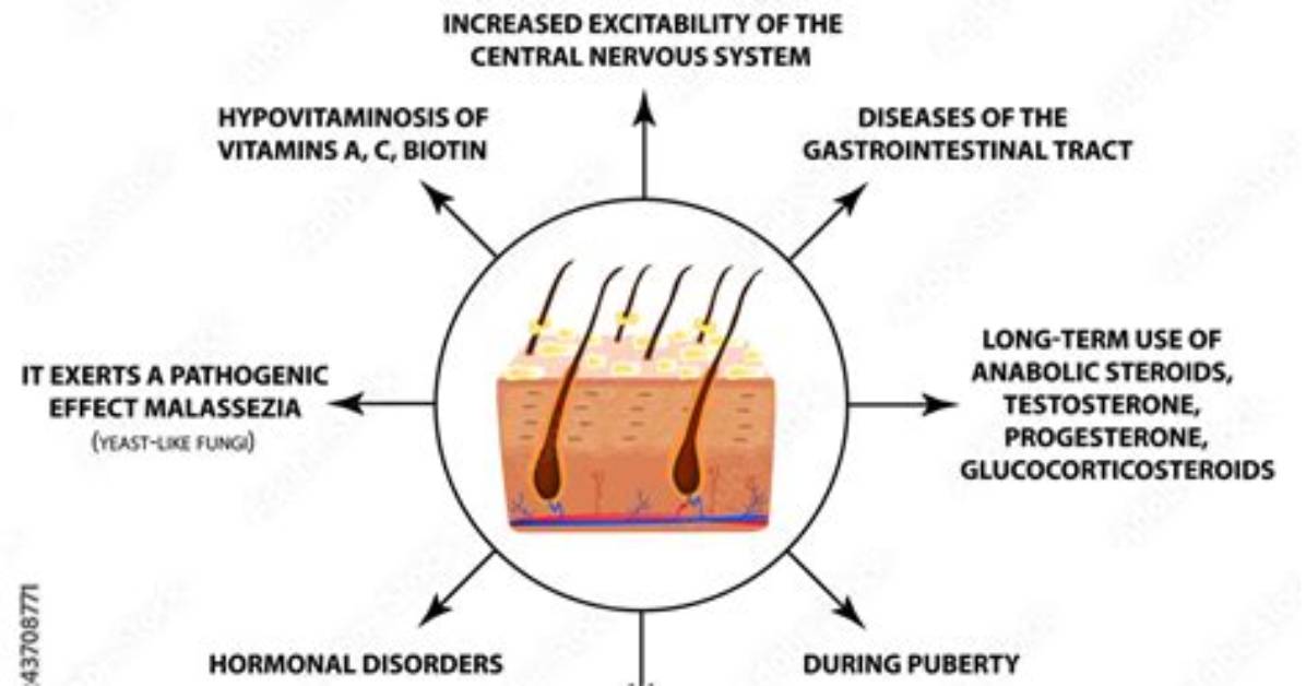 When Does Seborrhea Occur?