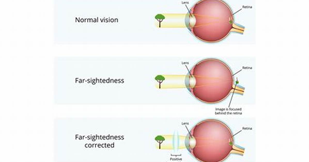 When Does Short Sightedness Stop Getting Worse?