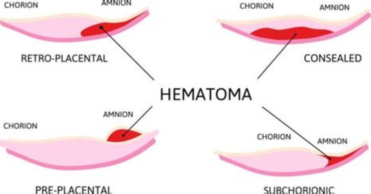When Does Subchorionic Hematoma Happen?