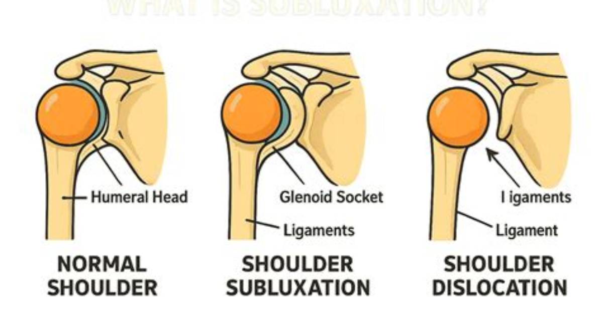 When Does Subluxation Occur?