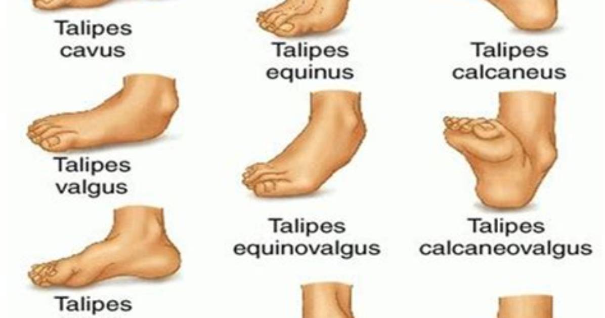 When Does Talipes Equinovarus Occur?
