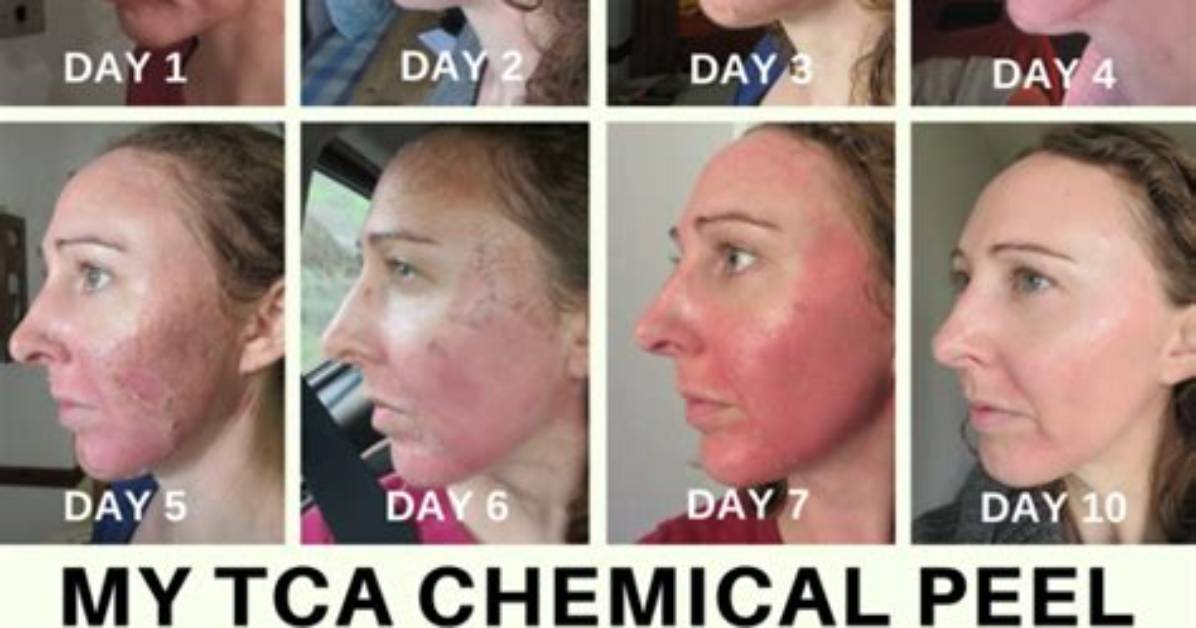 When Does Tca Peel Start Peeling?