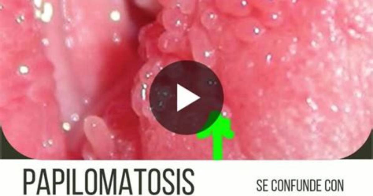 When Does Vestibular Papillomatosis Develop?