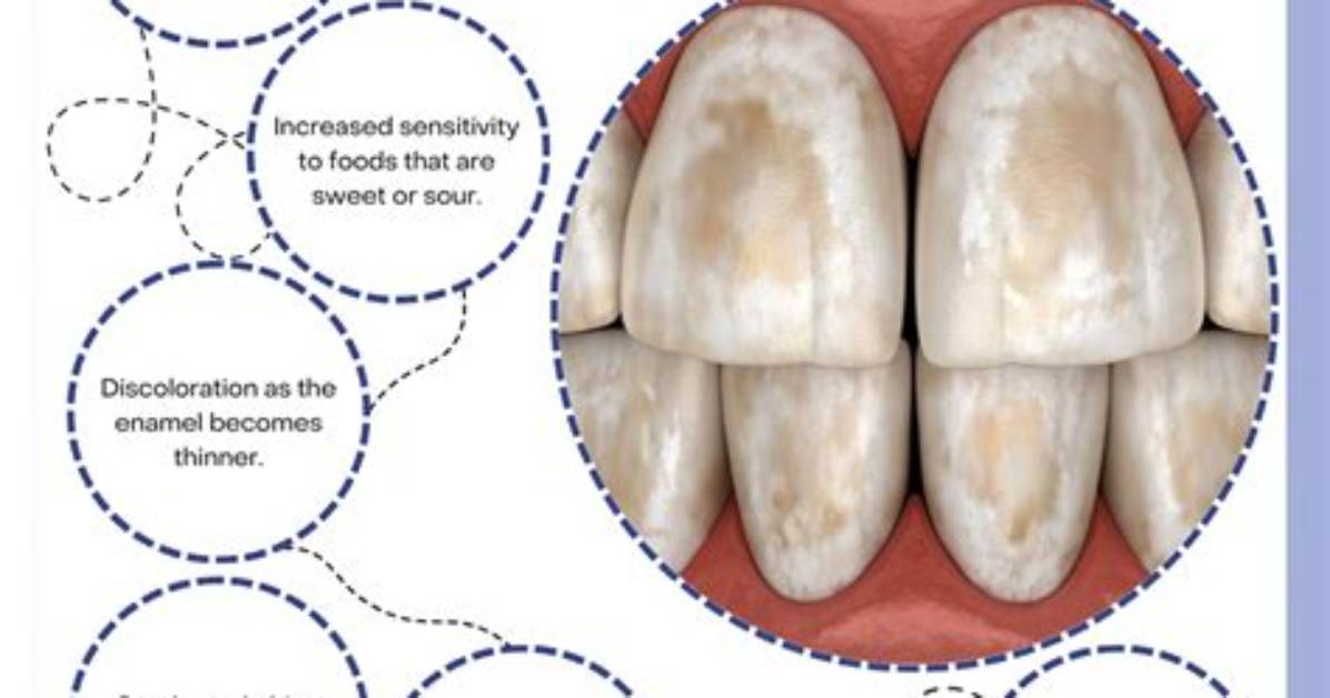 When Enamel Is Gone?