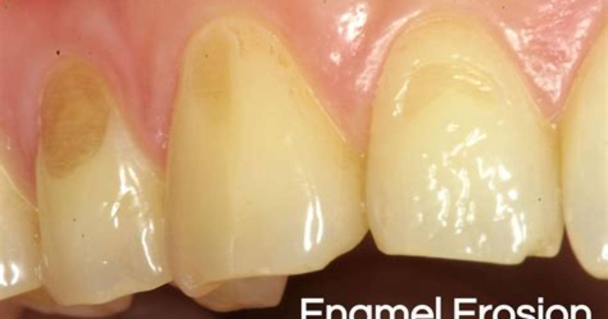 When Enamel Wears from Teeth?