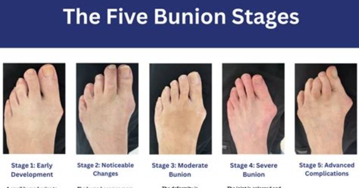 When Is a Bunion Severe?