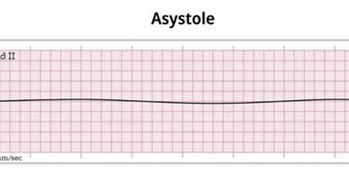 When Is a Pause Considered Asystole?