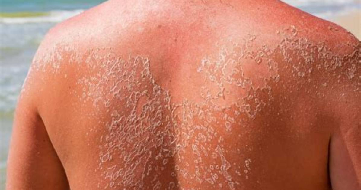 When Is a Sunburn Bad?