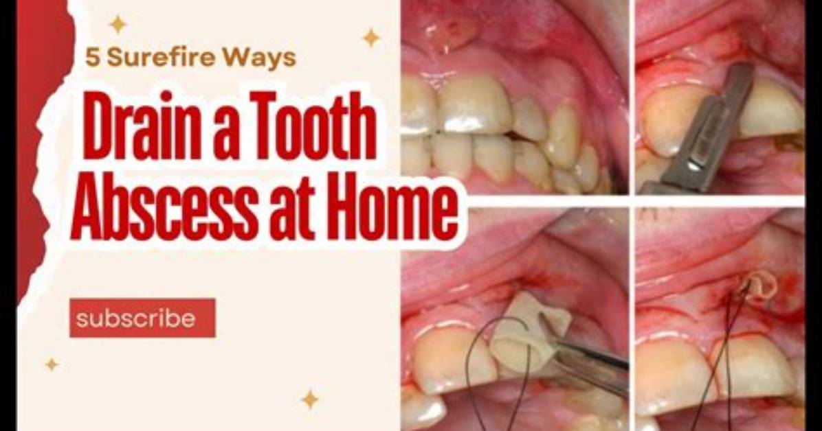 When Is an Abscess Drainable?