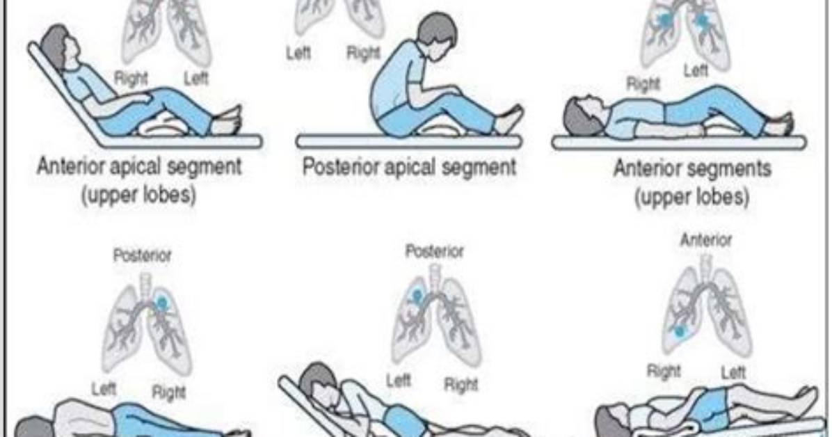 When Is Bronchial (Postural) Drainage Generally Performed?