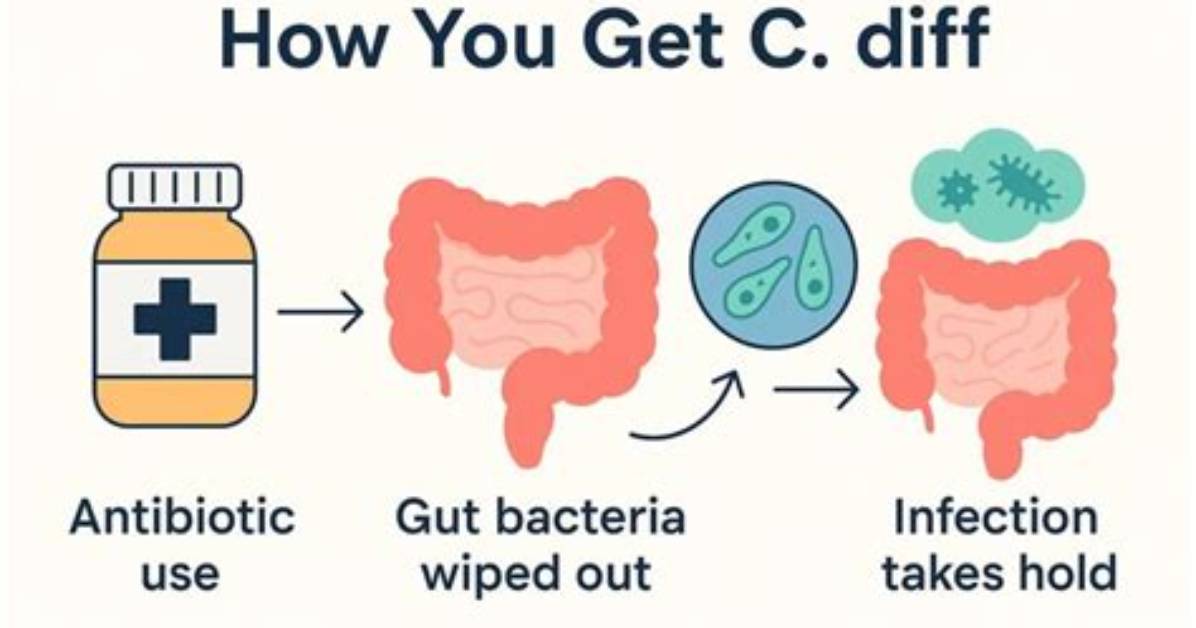 When Is C Diff No Longer Contagious?