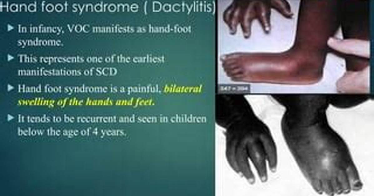 When Is Dactylitis Seen in Sickle Cell?