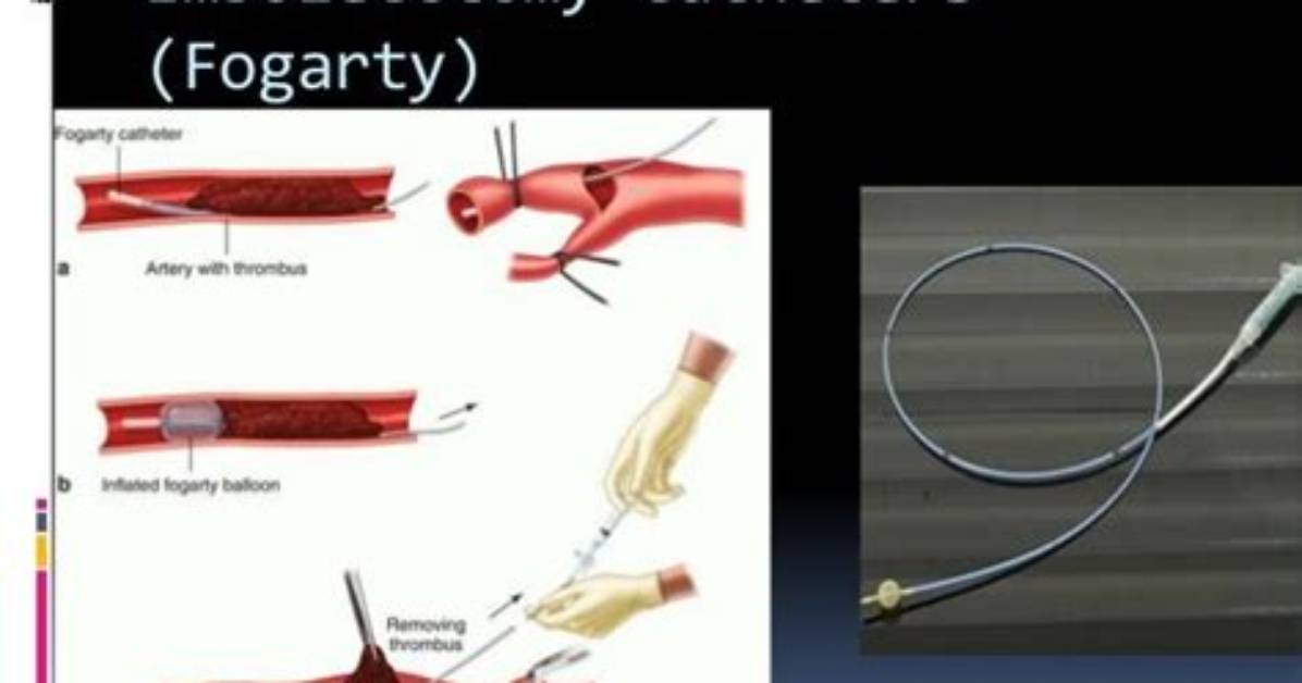 When Is Embolectomy Used?