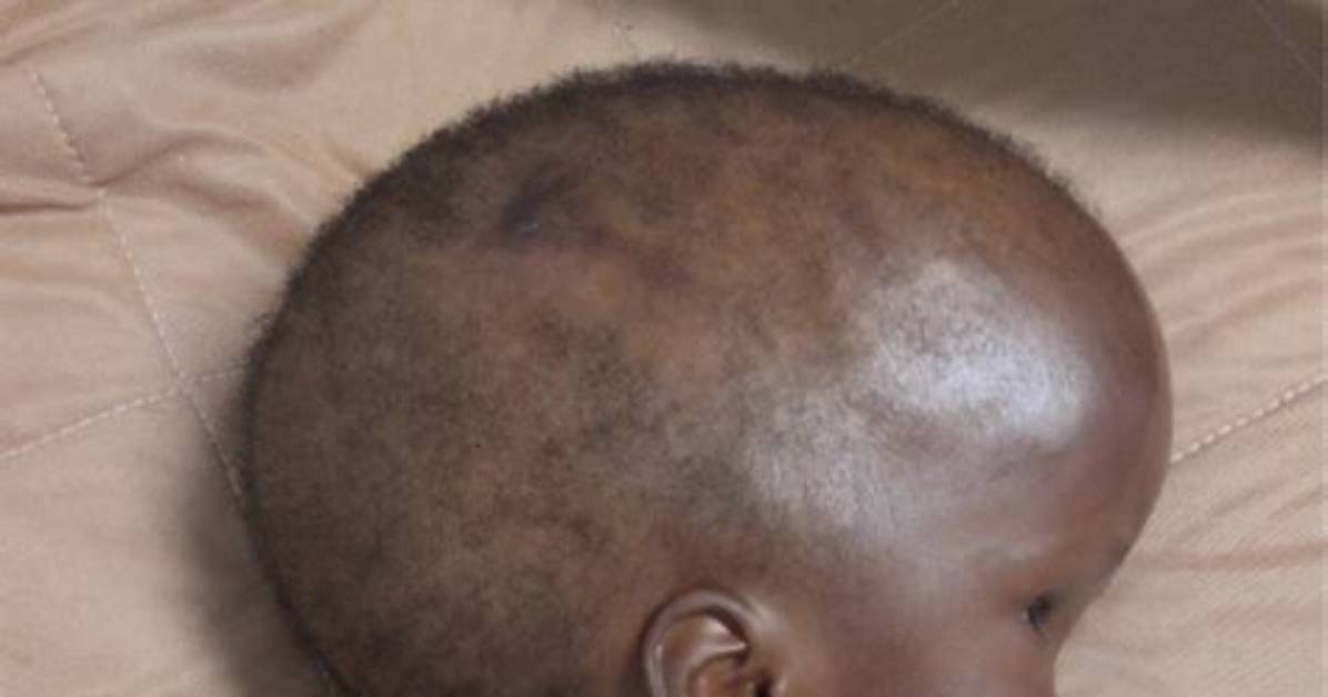 When Is Macrocephaly Diagnosed?