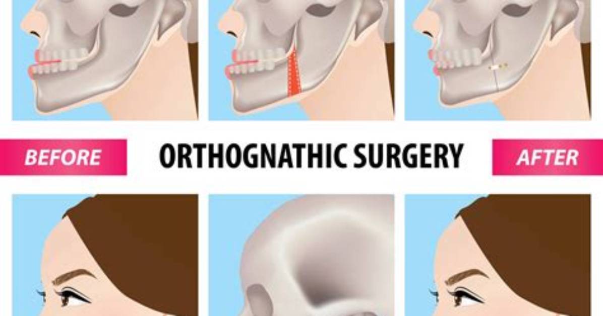 When Is Orthognathic Surgery Necessary?