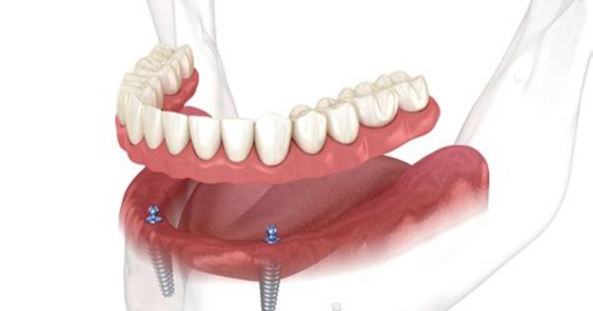 When Is Overdenture Used?