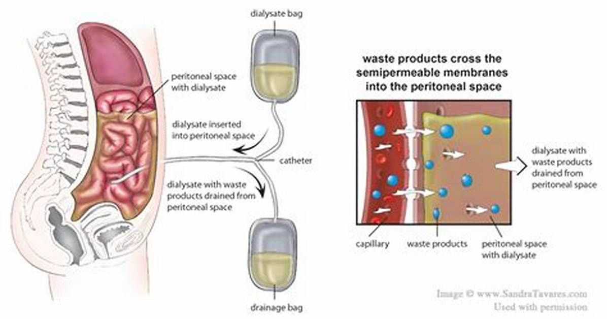 When Is Peritoneal Dialysis Used?