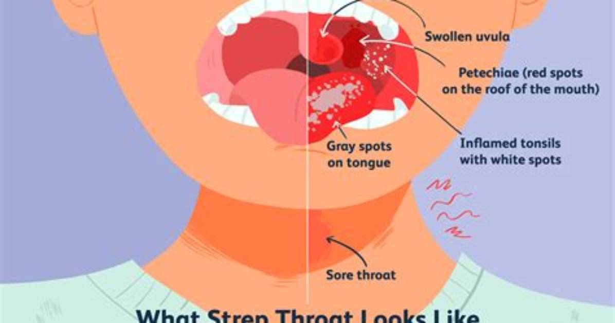 When Is Strep Throat Dangerous?