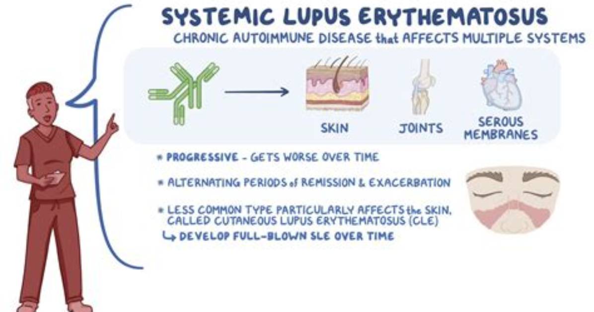 When Is Systemic Lupus Erythematosus?