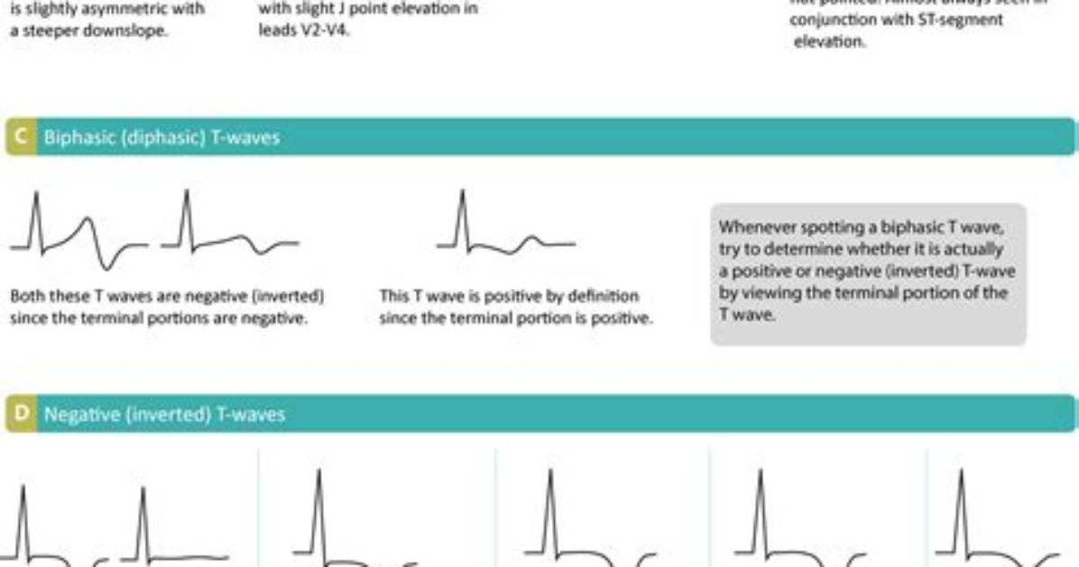 When Is T Wave Inversion Normal?