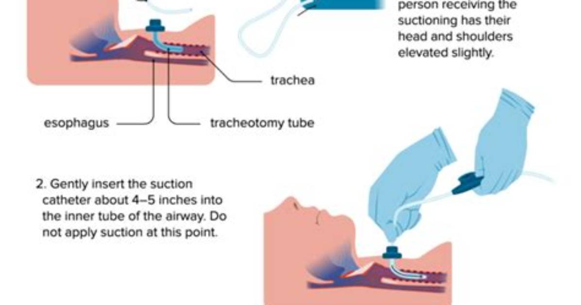 When Is Tracheal Suctioning Needed?
