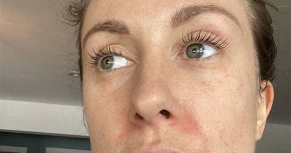 When Perioral Dermatitis Is Healing?