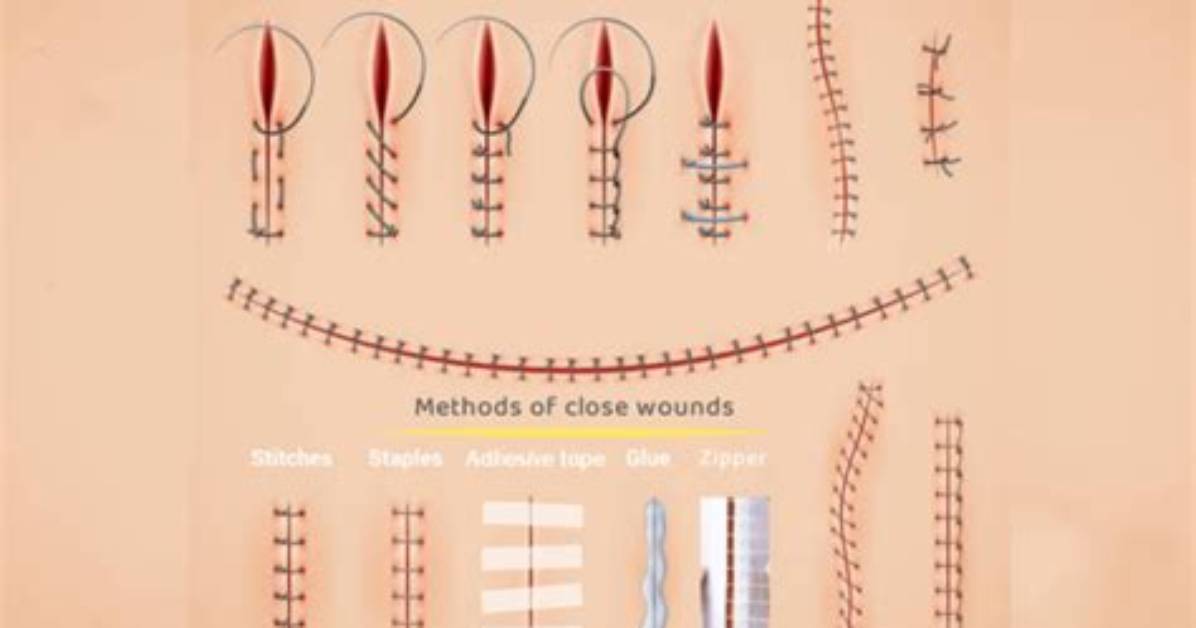When Should a Laceration Be Stitched?