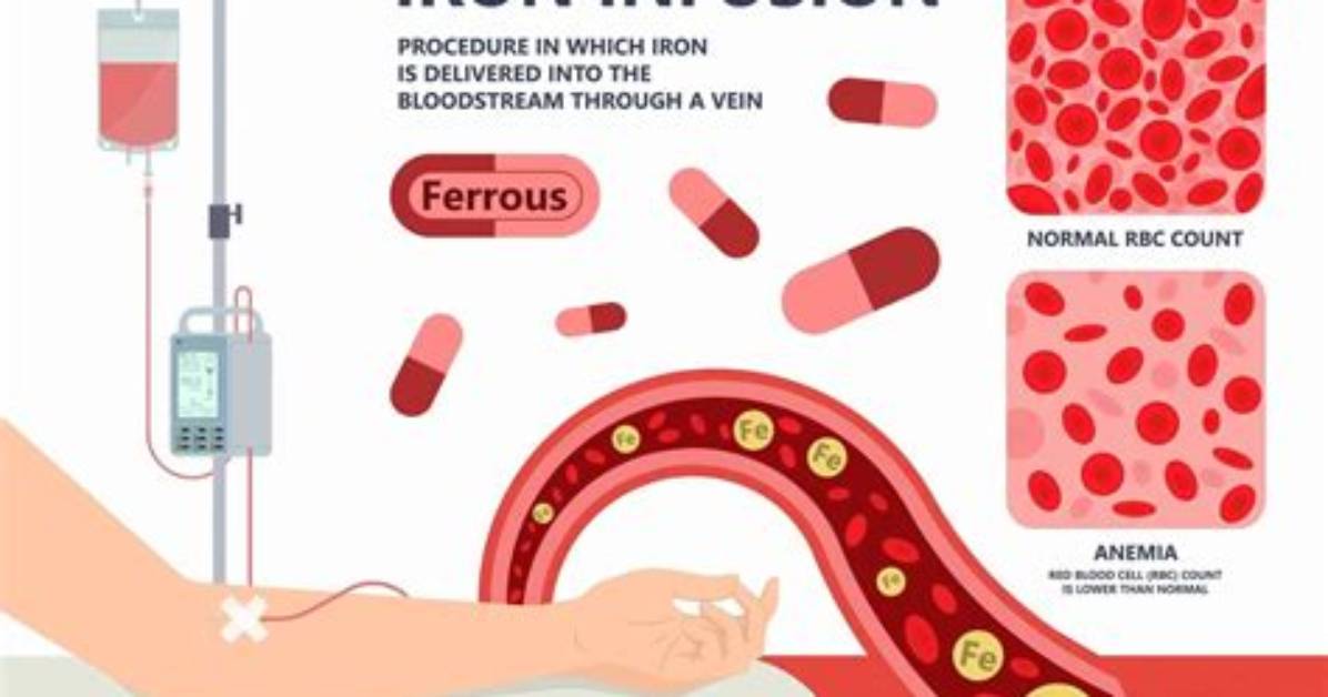 When Should Iron Infusions Be Given?