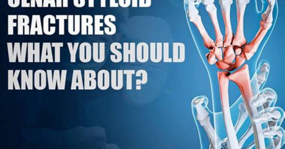 When Should Ulnar Styloid Be Fixed?