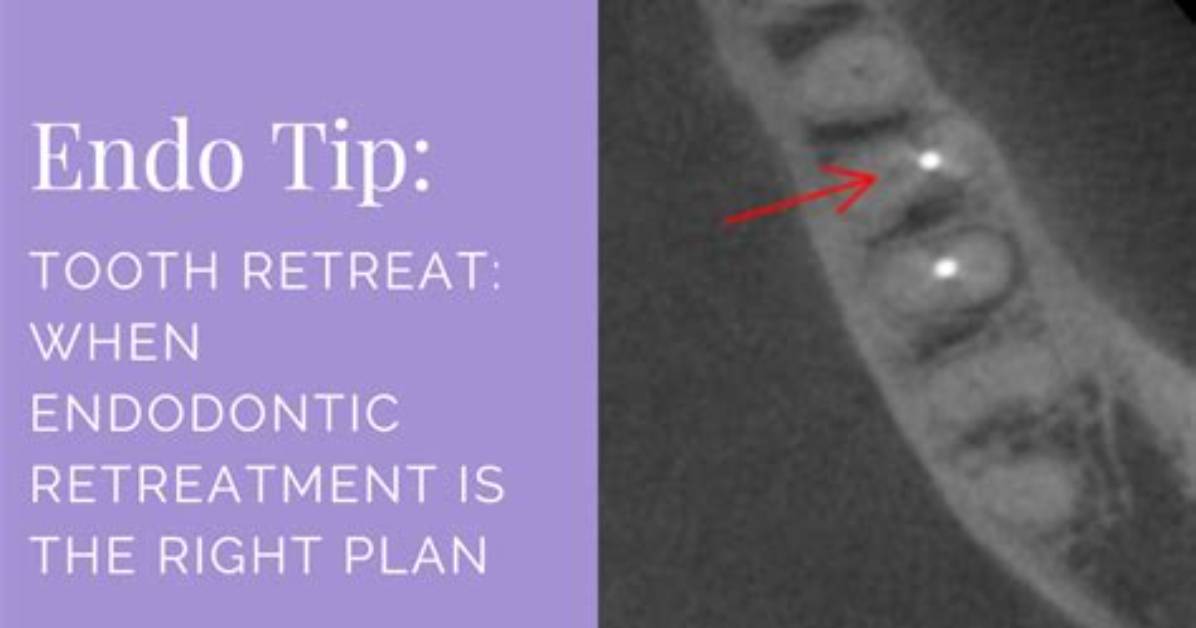 When to Do Endodontic Retreatment?