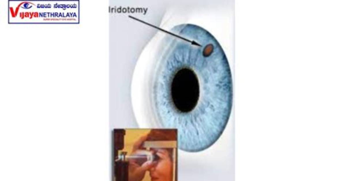 When to Do Iridotomy?