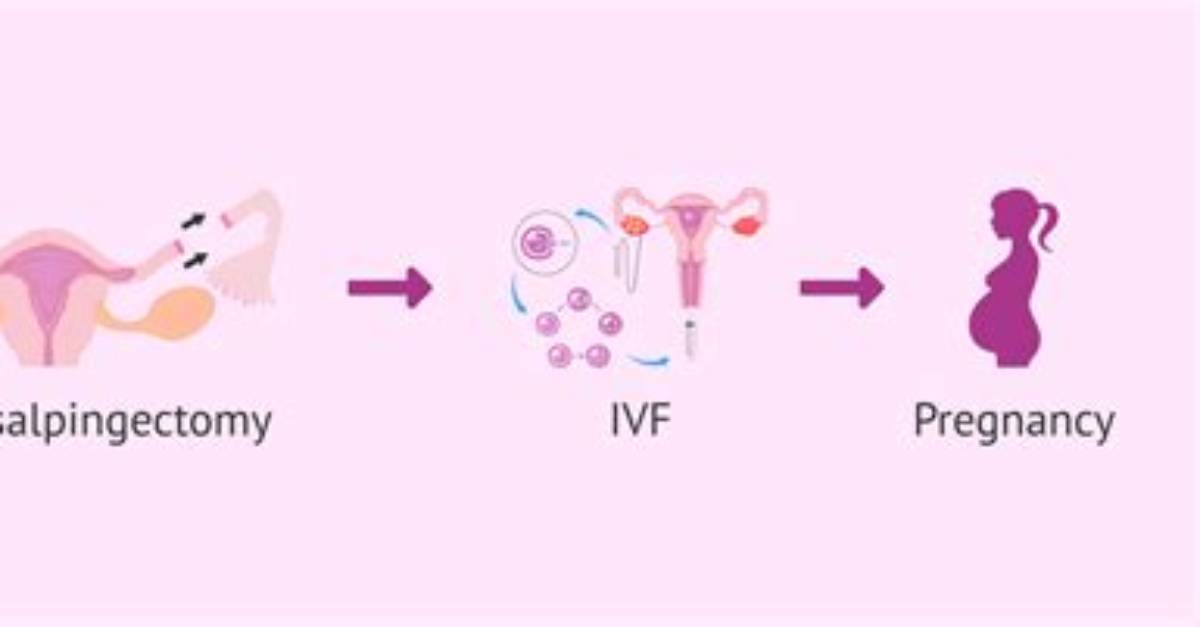 When to Do Salpingectomy?