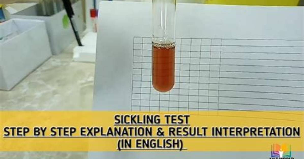 When to Do Sickling Test?