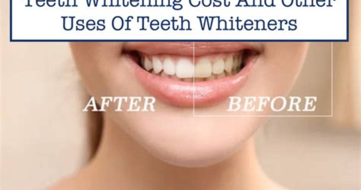 When to Do Teeth Whiteners?