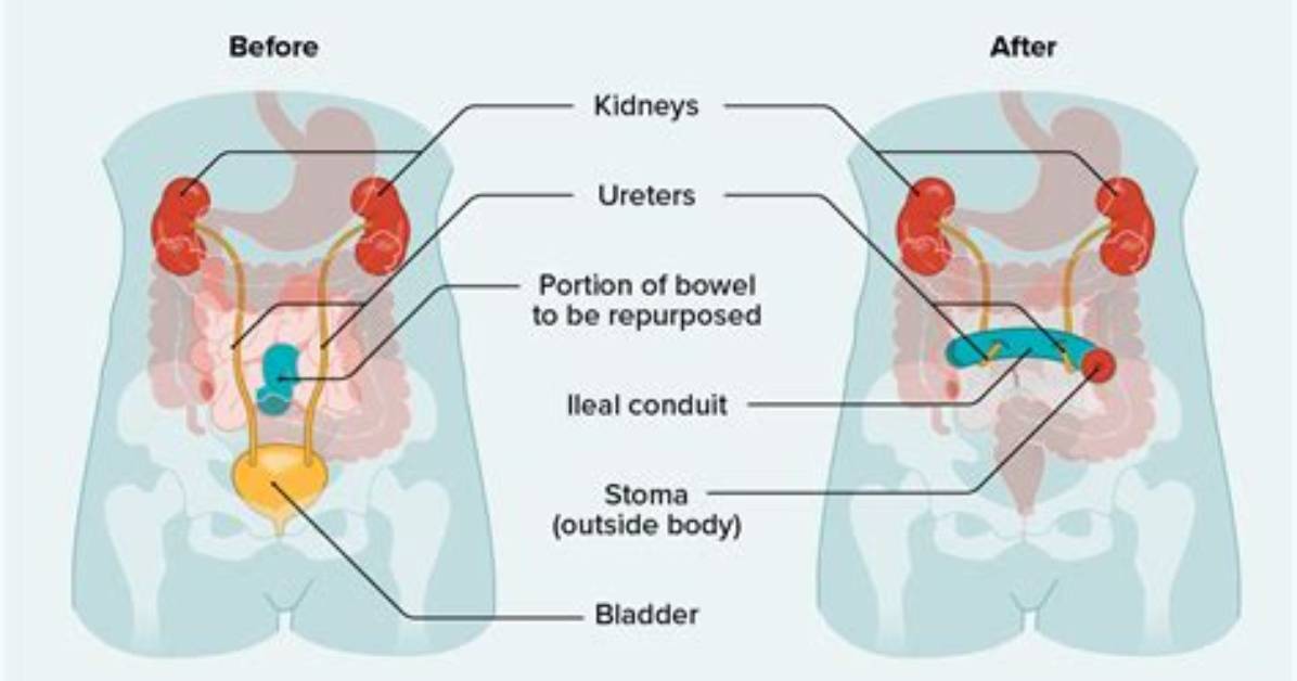When to Empty Ileal Conduit?