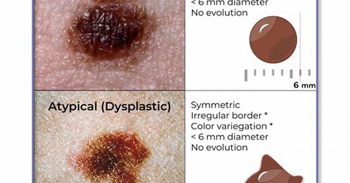When to Remove Dysplastic Nevus?