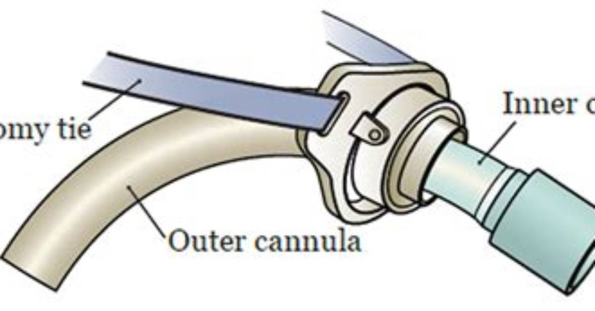 When to Remove Tracheostomy Tube?